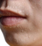 תסמונת קרצינואיד - תמונת אווירה